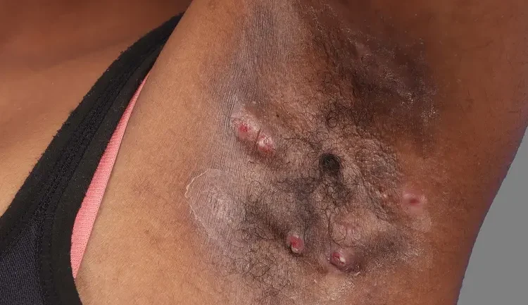 1800x1200_sciencesource_rm_hidradenitis_suppurativa_bigbead