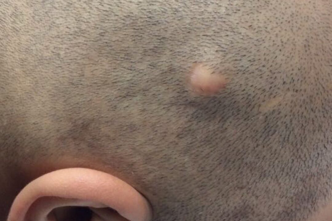 Pilar-Cyst-Removal