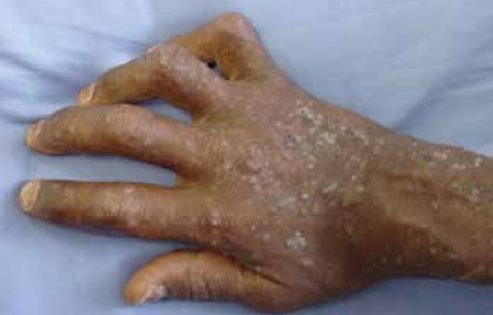 Psoriatic-arthritis-in-association-with-HIV-infection-there-is-extensive-psoriasis-with