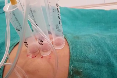 SUCTION-BLISTER-GRAFTING