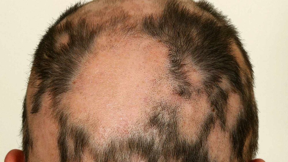 VWH-DermNetNZ-Alopecia-02-8594d84014464b3c9d21fae4db954234