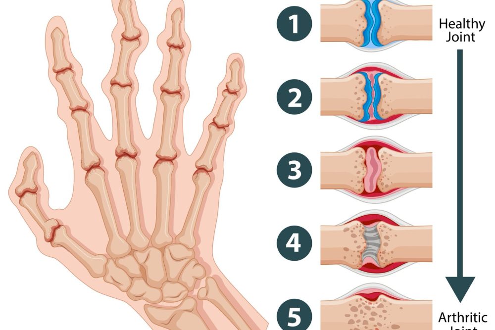 Inflammatory Arthritis - Acord Clinic - Dr Akash Singh