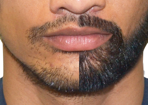 beard-restoration