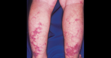 polyarteritis-nodosa